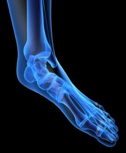 X-ray image of foot showing the bones affected by over pronation